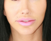 Feel Beautiful - Lip Filler Lip Lift - After Photo